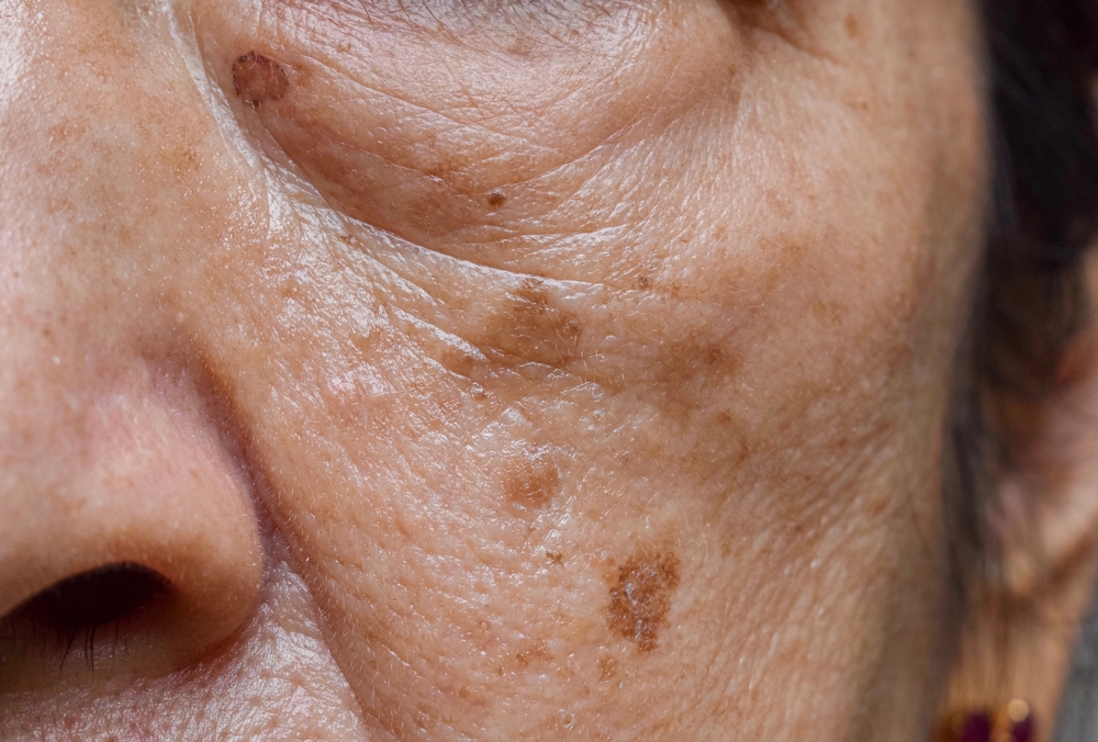 Small brown patches called age spots on face of Asian elder woman.