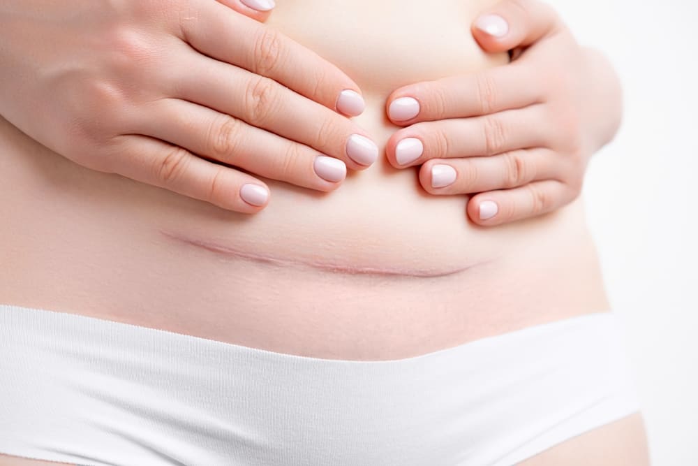 Woman showing hypertrophic scar after C-section.