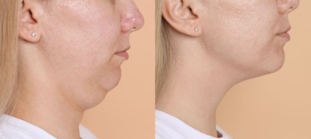 Close-up before and after double chin surgery on beige background.