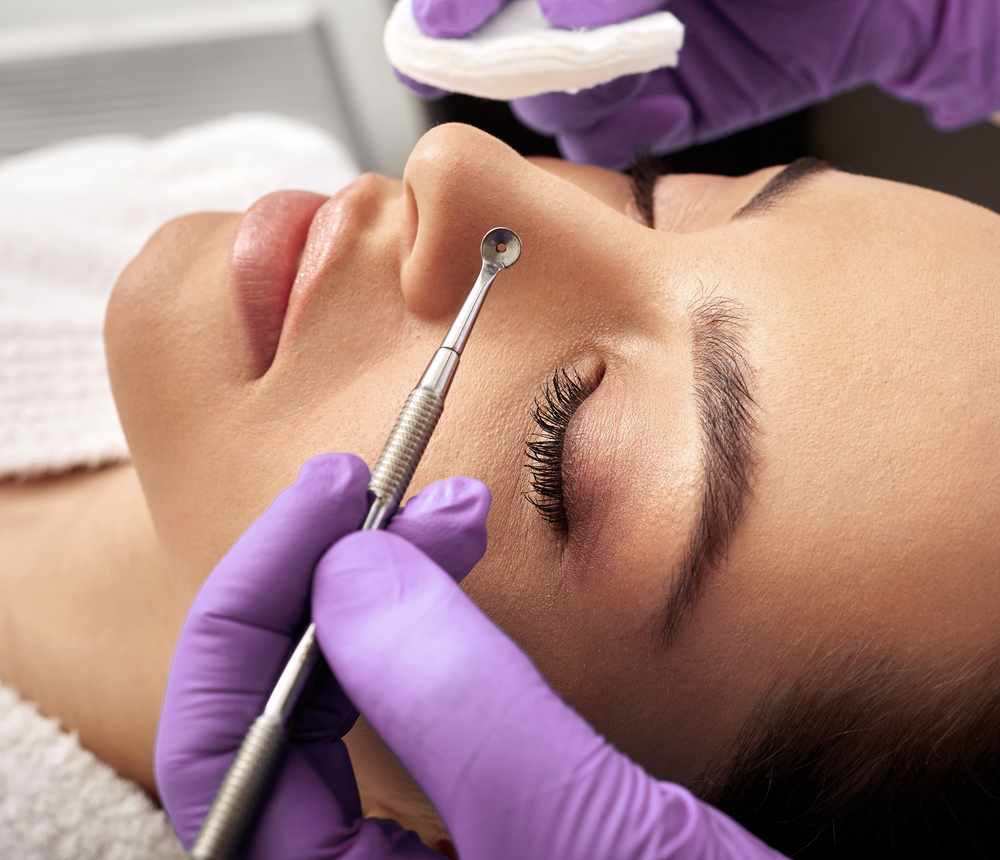 Facial cleansing to a woman with a mechanical blackhead extractor to remove comedones
